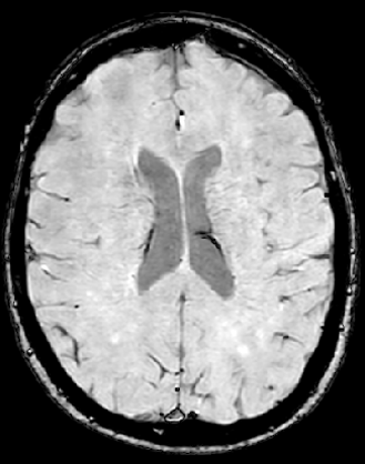 Susceptibility weighted imaging (SWI)